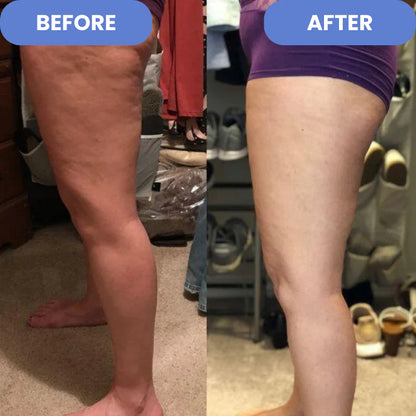 ProSculpt™  - Cellulite Treatment 4-in-1 -EBOOK GRATUITO DE REGALO