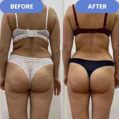 ProSculpt™  - Cellulite Treatment 4-in-1 -EBOOK GRATUITO DE REGALO